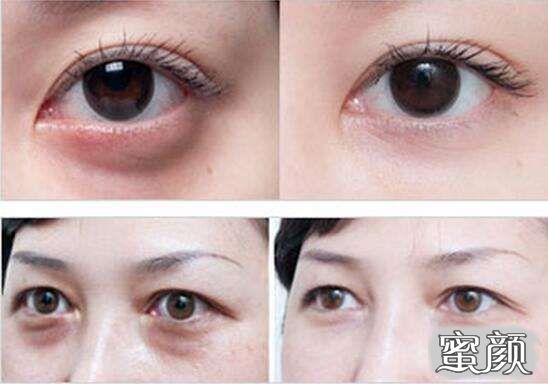 科技揭秘，最新去眼袋最佳方法，重塑眼部美麗新篇章！