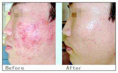 激光祛疤價(jià)格詳解，深度解析與觀點(diǎn)闡述