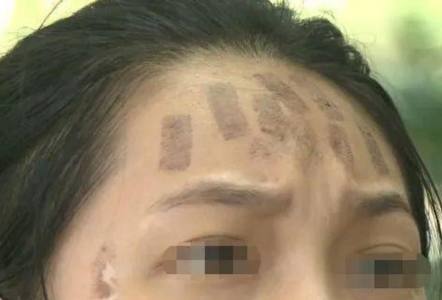 成都光子嫩膚價(jià)格，科技重塑肌膚之美