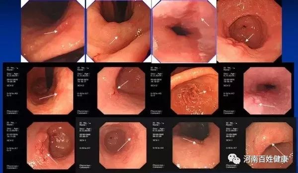 最新胃腸鏡技術(shù)，醫(yī)學(xué)領(lǐng)域的革新之星