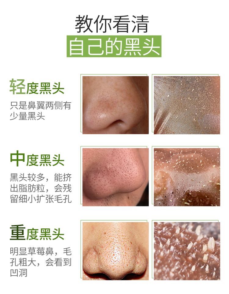 最新去黑頭教程視頻匯總，科技助力美麗重塑，黑頭無(wú)憂(yōu)新篇章