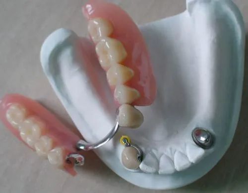 關(guān)于活動(dòng)假牙價(jià)格的探討與解析