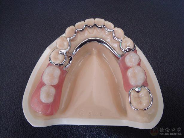 關(guān)于活動(dòng)假牙價(jià)格的探討與解析